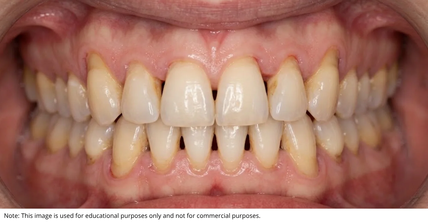 Exposed Tooth Roots and Gingival Recession INBLOG